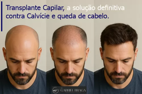 Transplante Capilar Goiânia