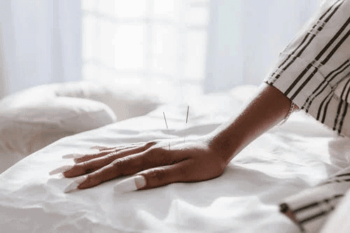 acupuntura3