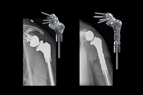 Advita Ortho Equinoxe Humeral Reconstruction Prosthesis for complex humeral bone loss and anatomic oncology application