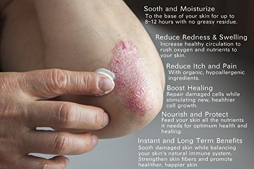 Psoriasis & Eczema Cream 4oz Advanced Healing Non-Greasy Moisturizer with Organic Aloe Vera, Manuka Honey, Hemp Oil & More. - Image 2