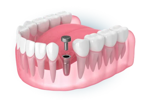Custom Dental implants