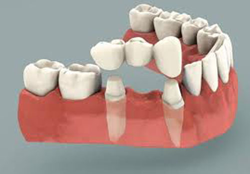 dental-bridges Dental Bridges
