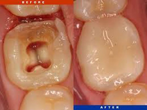 root-canal-before-after Root-Canal-Before-After