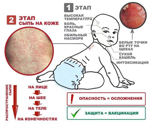 Разница между Корью и Опоясывающим лишаем 2 Корь у детей