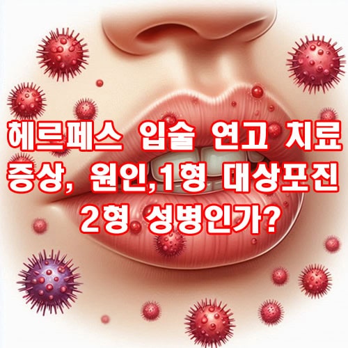 헤르페스 입술 연고 치료 [ 증상, 원인, 1형 대상포진, 2형 성병인가]