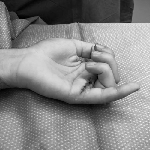 Foto einer Beugesehnenverletzung nach Schnittwunde, präoperativ