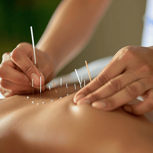 A close up of an acupuncture treatment being administered on a person's back. Several thin, metallic needles are inserted into the skin at specific points, with the practitioner's hands visible as they carefully place a new needle.