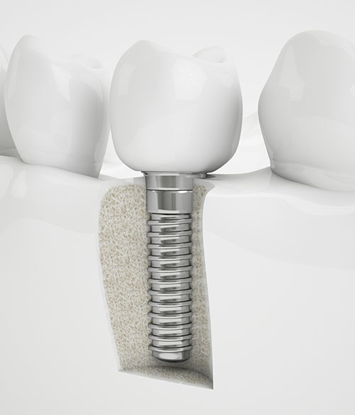 Implantes2-2-3
