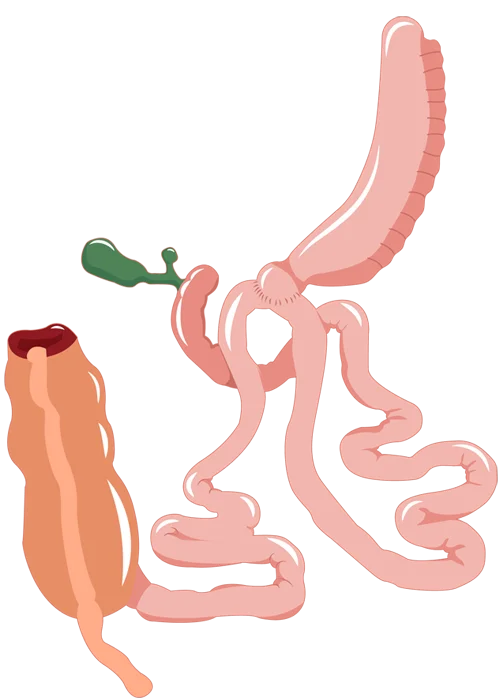 sadis surgery sadis surgery