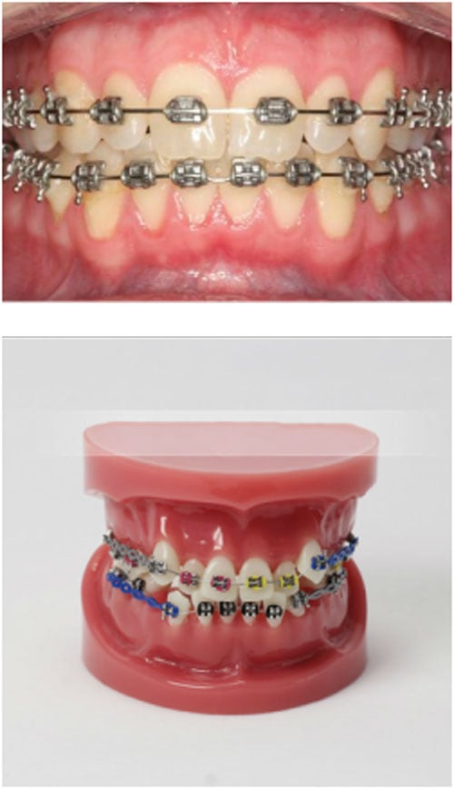 braces Braces