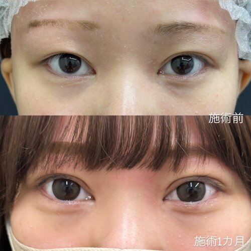 埋没法