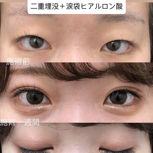 二重+ヒアルロン酸注入