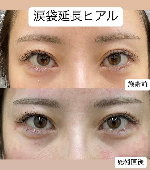 涙袋ヒアル