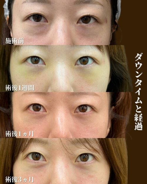 裏ハムラ法