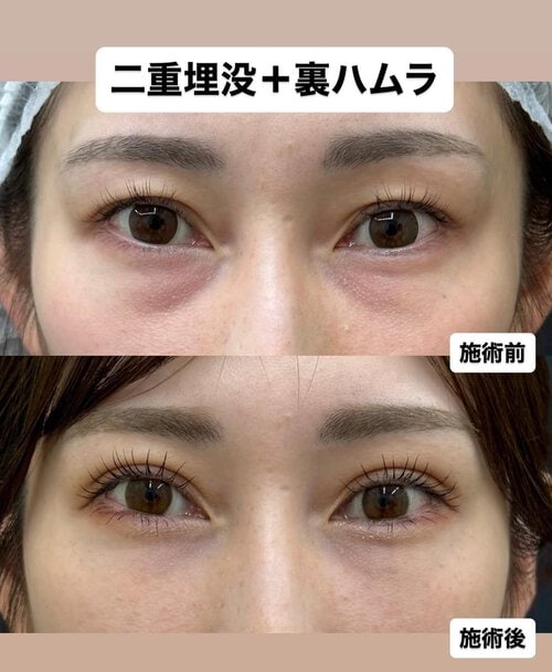 目周りの整形