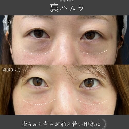 裏ハムラ法