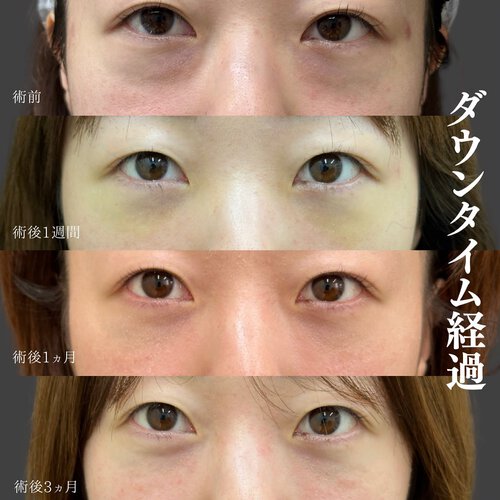 クマ取り治療症例