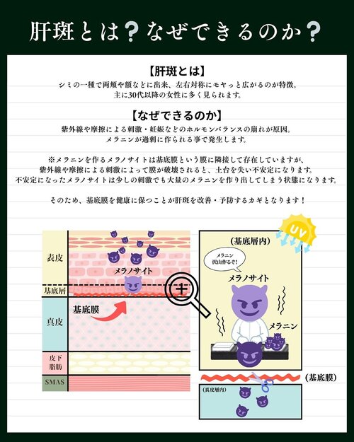 肝斑とは