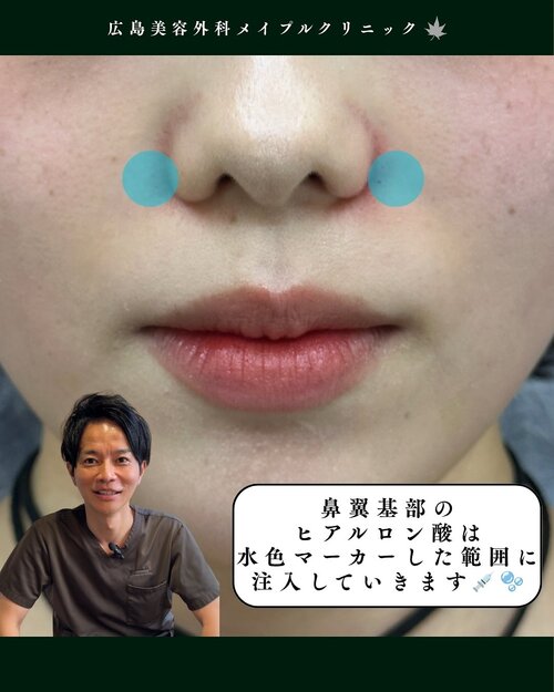 鼻翼基部