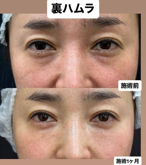 クマ取り治療