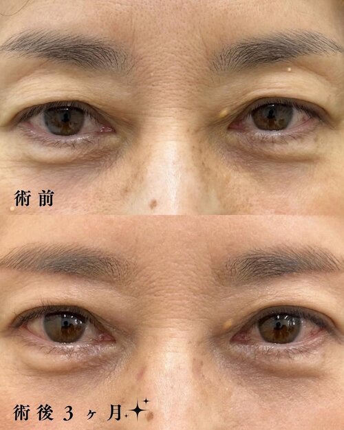 眉下切開