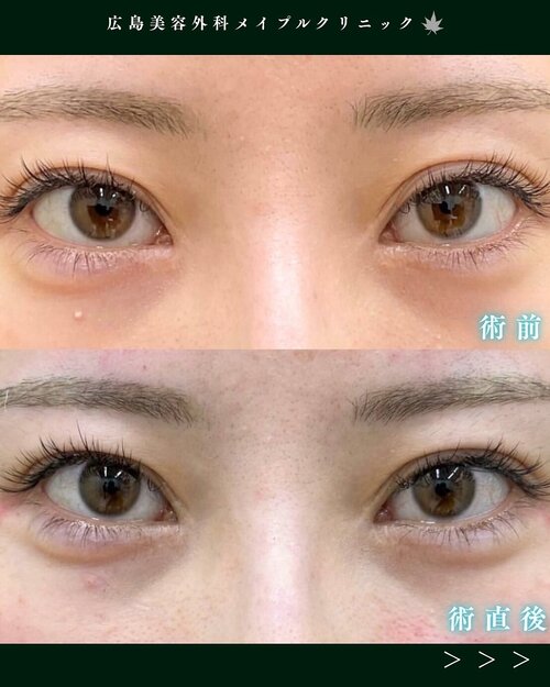 涙袋ヒアルロン酸注入