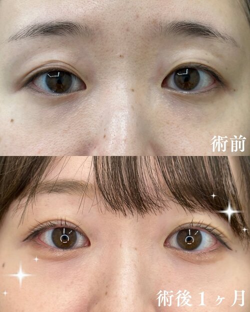 末広二重症例