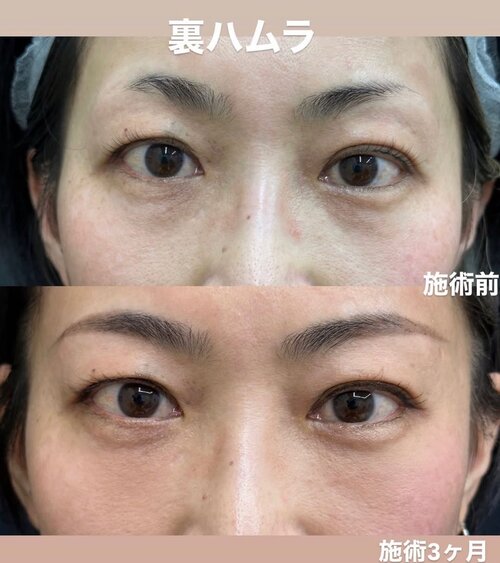 裏ハムラ法