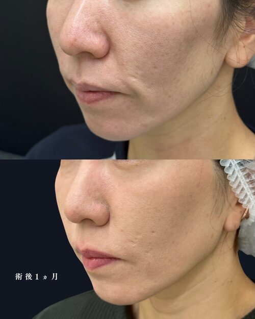 糸リフト