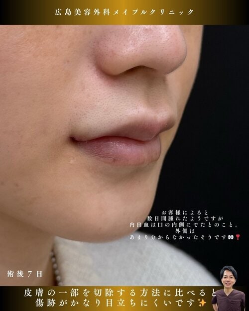 口角拳上症例