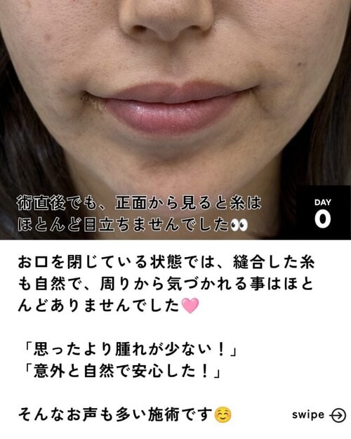 口角拳上施術後
