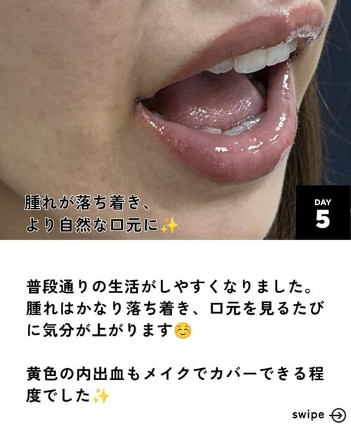 口角拳上5日後