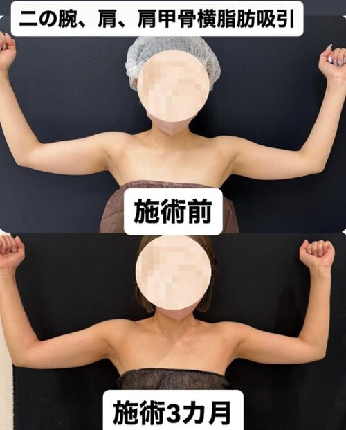 脂肪吸引