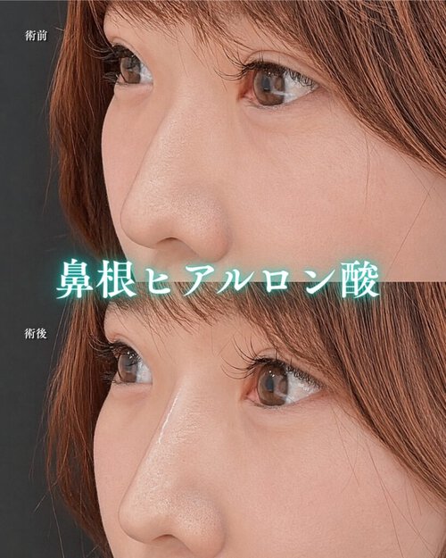 鼻根ヒアルロン酸注入