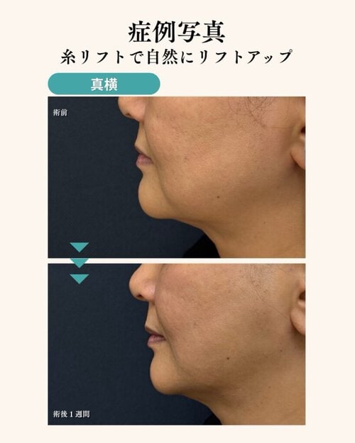 糸リフト症例横顔