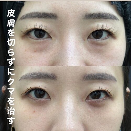 皮膚を切らずにクマを取る治療