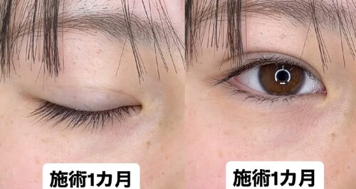 埋没法症例
