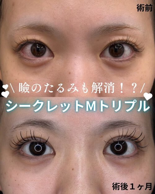 シークレットMトリプル