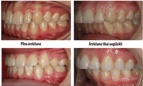 Orthodontic treatment , ortodontiskā ārstešana.