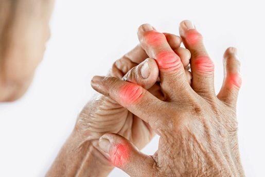Arthritis