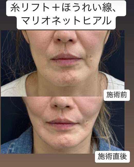 糸リフト