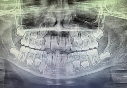 pantomogram zdjęcie zebów dla dzieci Wrocław