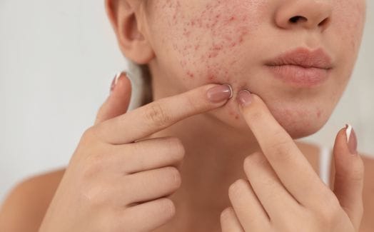 Mụn viêm nỗi phiền của nhiều người!