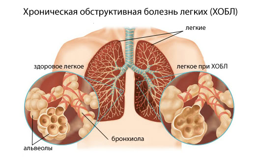 Разница между Асбестозом и Хронической Обструктивной Болезнью Легких 2 Здоровые лёгкие и при Хронической Обструктивной Болезни Легких (ХОБЛ)