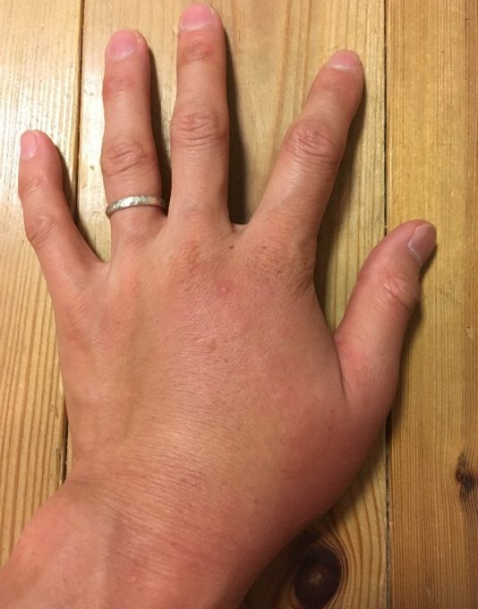 二次感染で腫れた左手