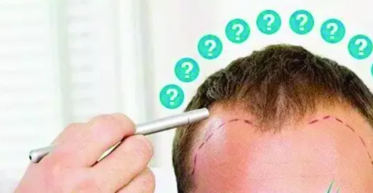 10 perguntas sobre transplante capilar