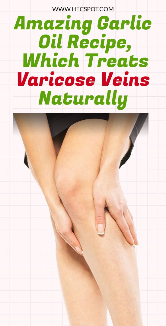 Garlic Prevents The Inflammation That Cause Varicose Veins Here is
