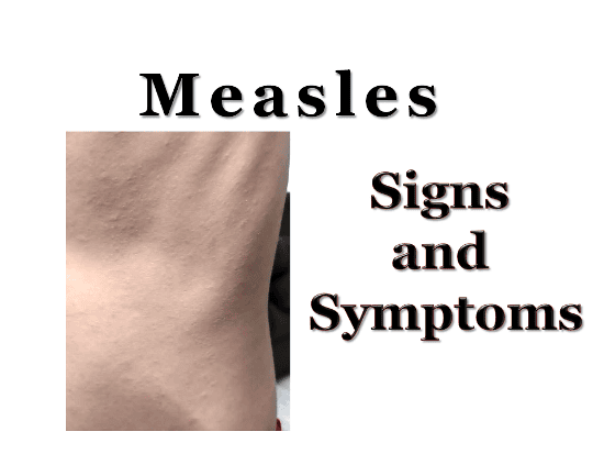 measles, definition, signs and symptoms, complications, prevention, treatment