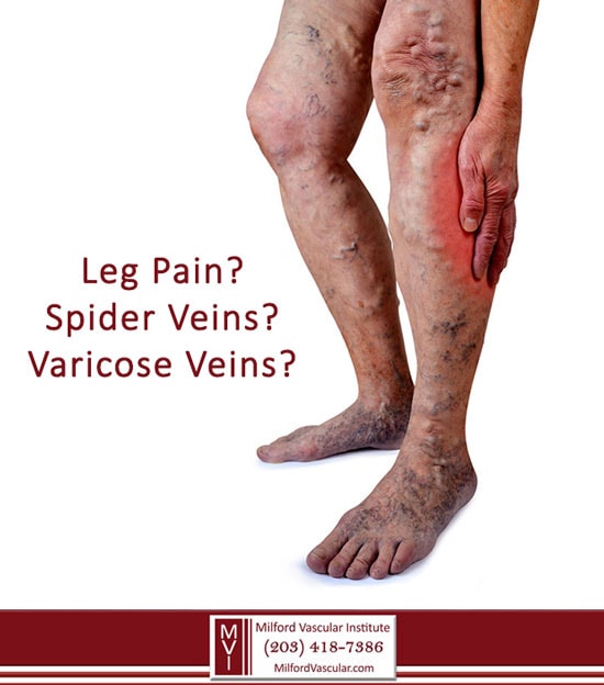 Venous Insufficiency New Haven CT Venous Insufficiency New Haven CT