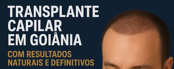 Transplante Capilar com Especialistas em Goiânia